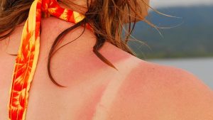 Get rid of sunburn skin