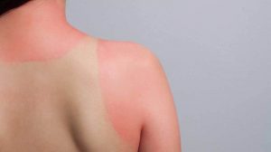 Remedy for Sunburn Skin