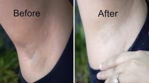 Tips To Get Rid Of Dark Underarms
