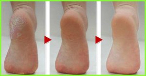 Dead Skin For Feet