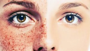 Skin Against Sun Damage