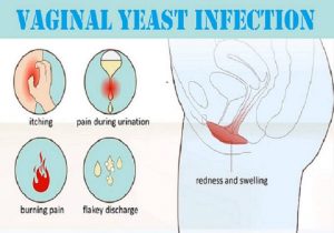 Treating Yeast Infection
