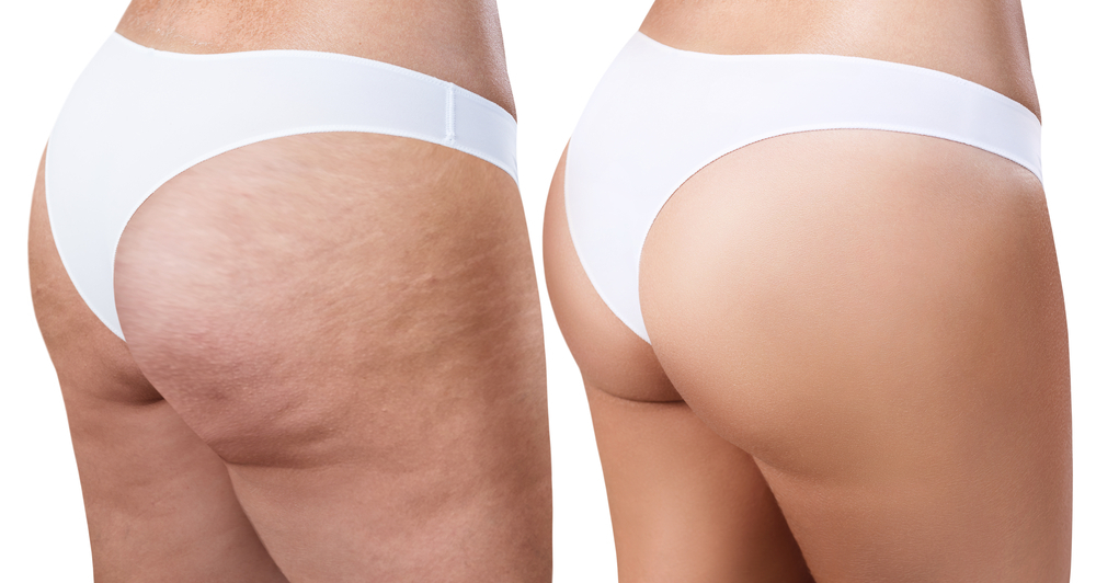 cellulite